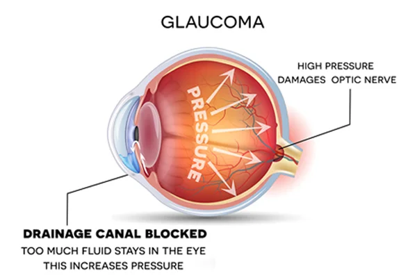 Glaucoma