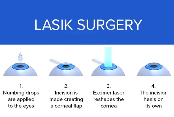 LASIK Eye Surgery